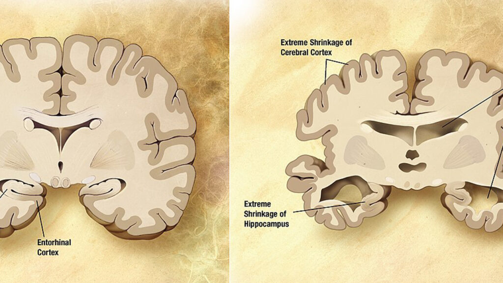 diagnosi Azlheimer